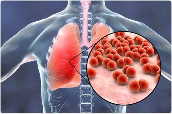 The Global Impact of Pneumonia on Public Health Pneumonia