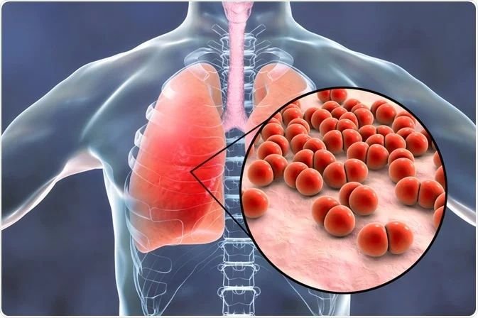 Pneumonia