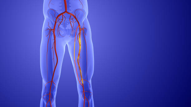 Peripheral Vascular Disease